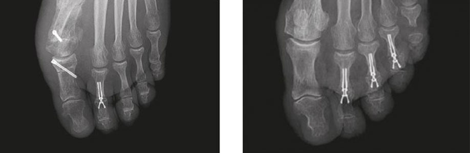 lync-xray