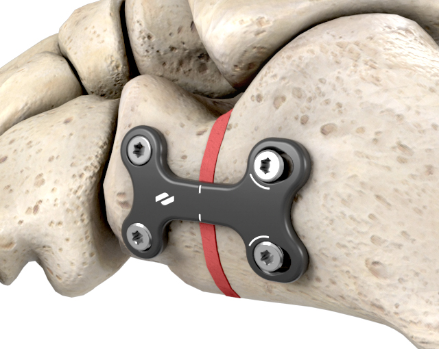 evans-osteotomy
