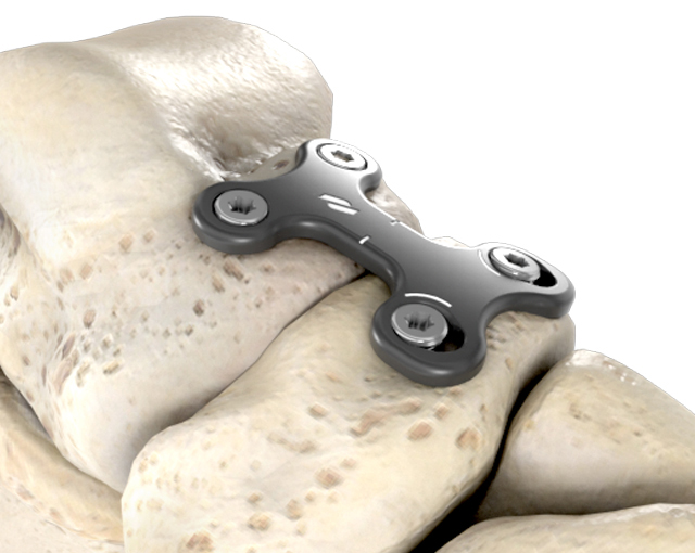 talo-navicular-implant